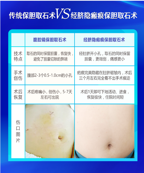 保胆取石术:小小肚脐 为保胆取石披上“隐形衣”